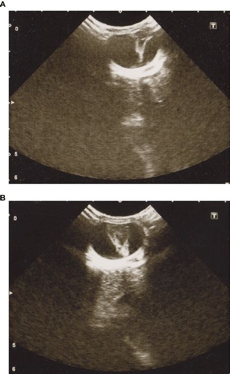 Ocular B Scan Ultrasonography Transverse Section At 2 Days Of Age