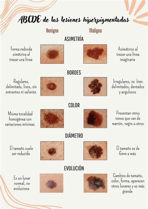 Tarea Sesión 13 ABCDE de las lesiones hiperpigmentadas ASIMETRÍA