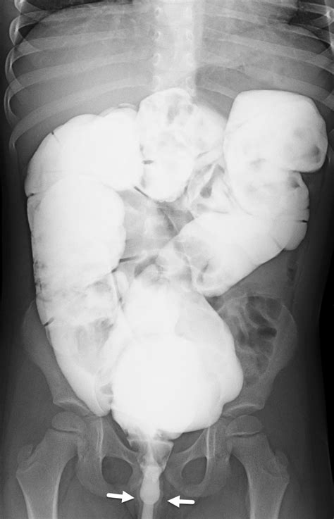 Severe Constipation X Ray