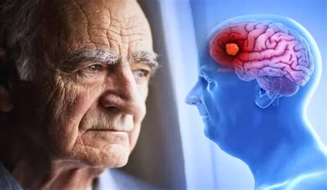 Lewy Body Dementia Understanding The 7 Stages