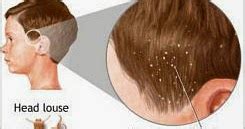 Head lice Or Head Nits Symptoms And Treatment - Health And Medical Information