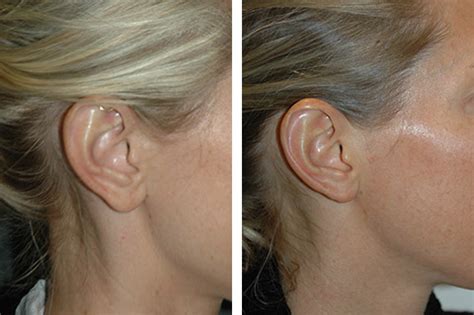 Ear Lobe Surgery : Earlobe repair or split earlobe surgery is a quick ...