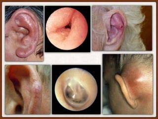 Common Ear Disorders PPT