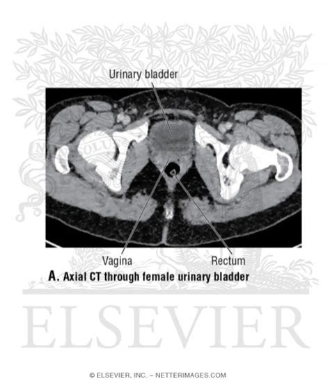 Axial Ct Through Female Urinary Bladder