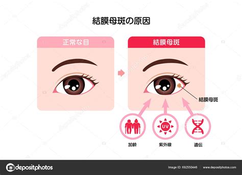 Causes Conjunctival Nevus Vector Illustration Stock Vector by ©barks ...