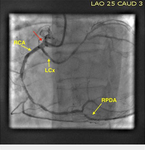 Figure From Anomalous Aortic Origin Of Coronary Arteries From The