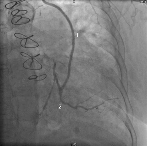 Coronary Angiography Showing The Patent Coronary Artery Bypass Graft