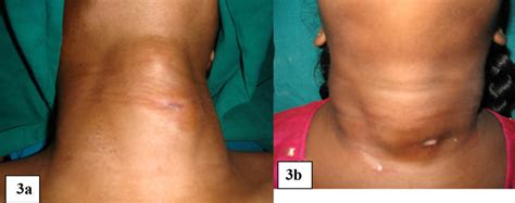 A Clinical Photograph Of 15 Year Old Girl With Fistula In Left Neck