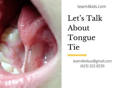 tongue-tie symptoms Archives - TEAM4Kids