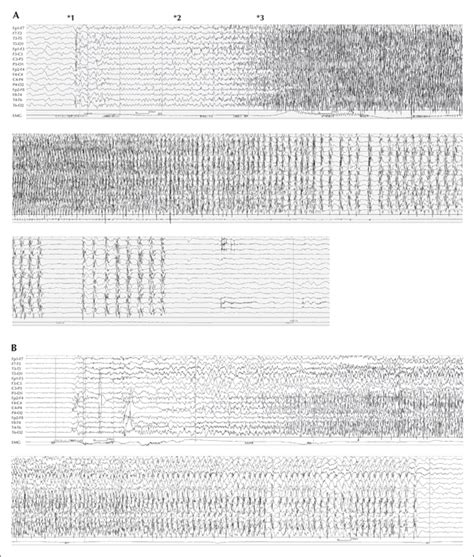 Jle Epileptic Disorders Characteristic Phasic Evolution Of