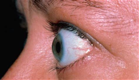 ophthalmology: EKZOFTALMI