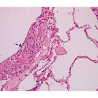 Lymphangioleiomyomatosis Lam High Resolution Ct Scan In Axial A