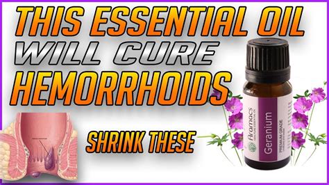 Top Essential Oil For Hemorrhoids That Actually Works How To Get Rid Of Hemorrhoids Youtube