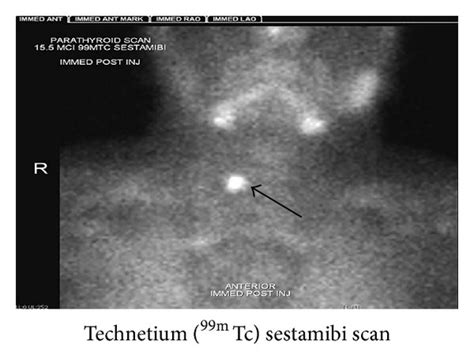 Ultrasound A And Technetium Tc M Sestamibi Scan B Of