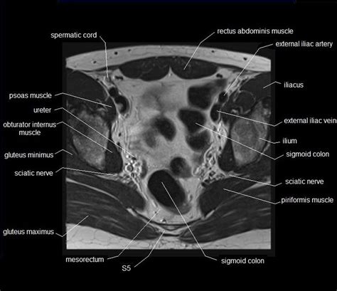 107 best images about radiology anatomy on Pinterest | Brain anatomy ...