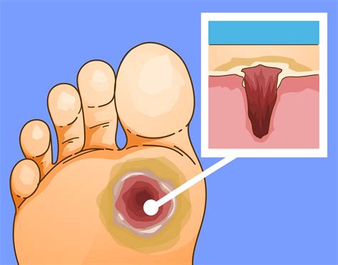 Diabetischer Fuss Universit Tsklinik F R Angiologie