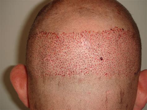 Follicular Unit Extraction Tips Before And After Surgery Hair Loss