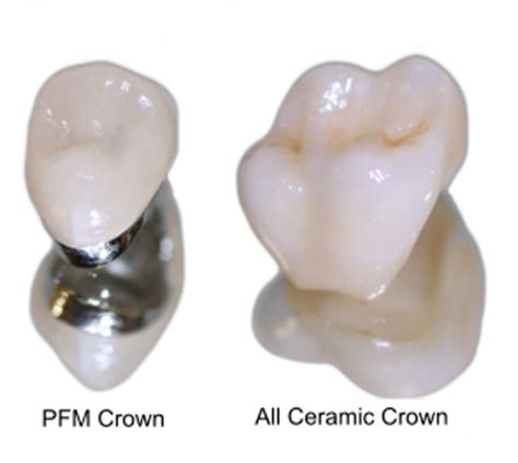 Dental Crowns In Lichfield