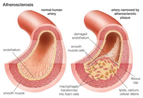 An Overview of Atherosclerosis