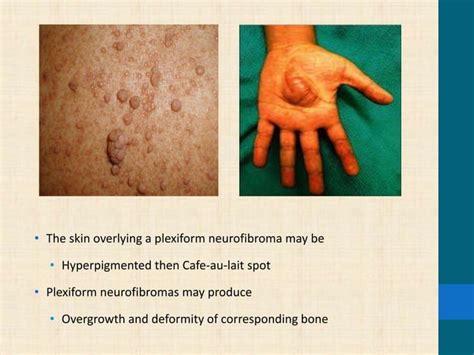 NEUROCUTANEOUS SYNDROME