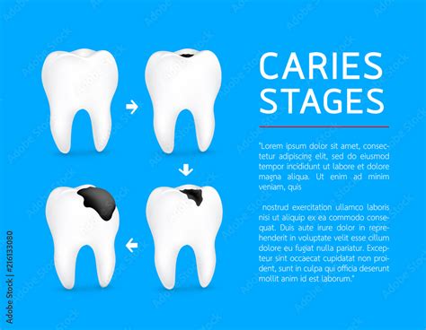 tooth   stages  dental caries development enamel caries