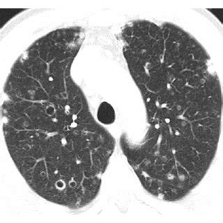 Axial Thoracic Ct Image Lung Window In A Lower Thoracic Ct Slice