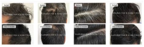 Effective Scalp Infection Treatment and Hair Thinning Solutions in ...