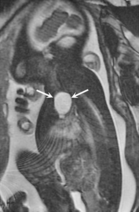 Complete anotia is depicted on coronal T2-W MR image in this 21-week... | Download Scientific ...