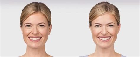 Botox Cosmetic Before After Gallery