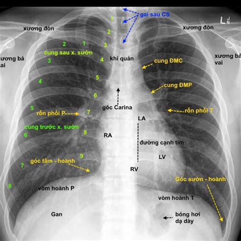 Hiểu Biết Giải Phẫu Trên X-Quang Ngực Thẳng: Chìa Khóa Chẩn Đoán Hình ...
