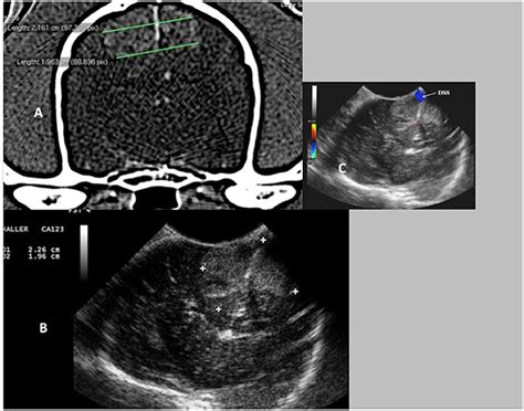 Frontiers Intraoperative Ultrasound Applications In Intracranial Surgery