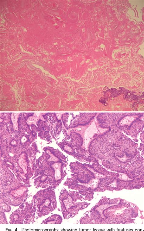 Figure From Primary Intracranial Ectopic Craniopharyngioma In A