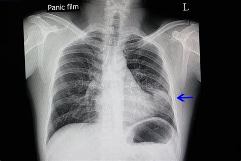 Chest X Ray Of Pneumonia Image