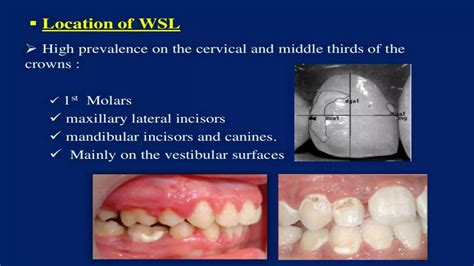 Control Of White Spot Lesions Using Fluoride Varnish In Orthodontic