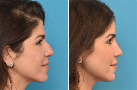 Rhinoplasty 101 Your Guide To Correcting A Crooked Nose