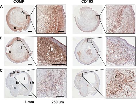 Cartilage Oligomeric Matrix Protein Associates With A Vulnerable Plaque