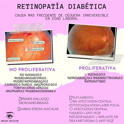 RETINOPATÍA DIABÉTICA NeuroMedicine uDocz