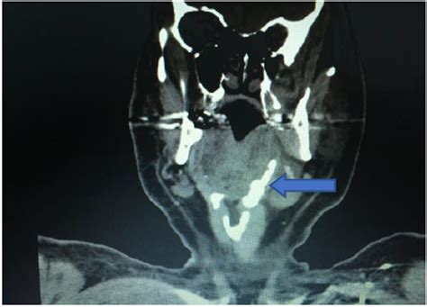 Figure 2 CT Neck Coronal Image Showing Calcification Of Left