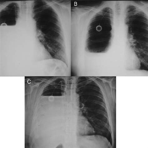 Post-pneumonectomy chest X-ray films in patient with BEPS. ( A ...