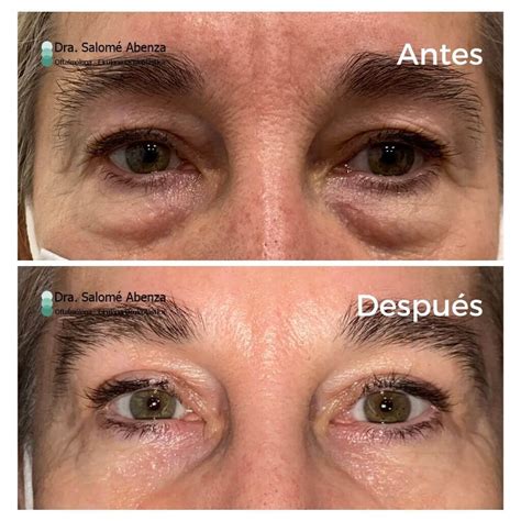 Blefaroplastia Superior Y Blefaroplastia Inferior Con Cantopexia