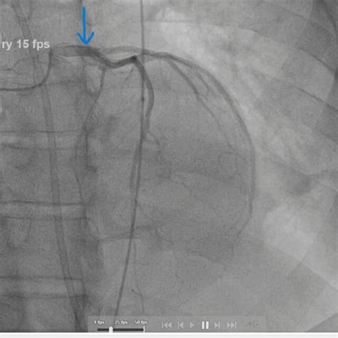 Coronary angiography showing flow in LAD artery with no... | Download ...