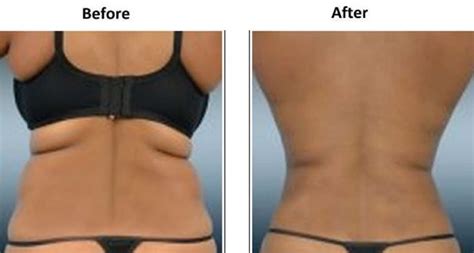 Back Braline Aesthetics Face And BodySculpting