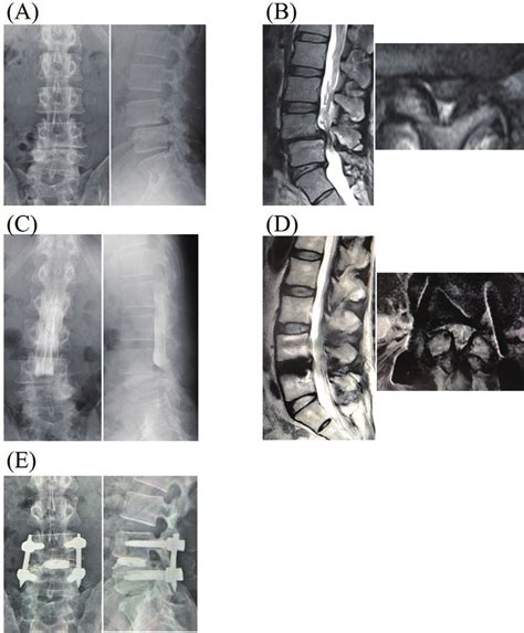 A Plain Radiograph Showing Meyerding Grade Spondylolisthesis At L