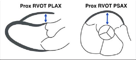 Measurement Of Right Ventricular Outflow Tract Rvot Dimensions Download Scientific Diagram