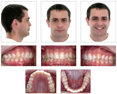 Class Ii Division 2 Subdivision Left Malocclusion Anterior Deep Bite And Tmd