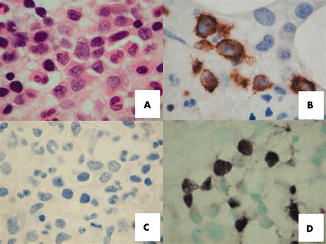 Diagnostic Cues For Natural Killer Cell Lymphoma Primary Nodal Presentation And The Role Of In