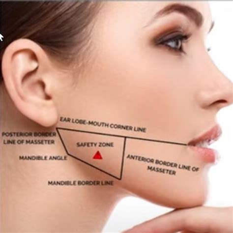 Masseter Reduction Botox Pattern To Avoid Dr Tim Pearce