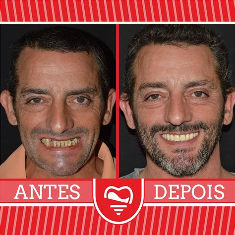 Implantes Dent Rios Antes E Depois Implantes Dent Rios Dent Rio