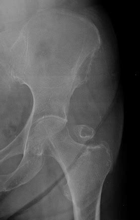 Trochanteric Fracture