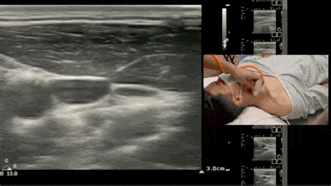 Ultrasound Guided Central Venous Catheter Placement A Structured The